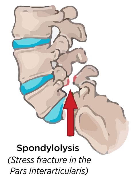 spondylolysis.